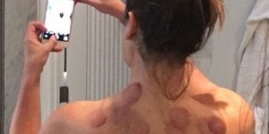 Η ηθοποιός Λι Μισέλ φωτογραφίζεται μετά από τις βεντούζες
