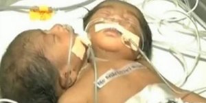 Σοκ στην Ινδία: Γεννήθηκε μωρό με δυο κεφάλια [βίντεο]