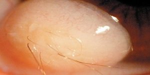 Από το βολβό του ματιού νεαρού Ιρανού φυτρώνουν... τρίχες [εικόνες]