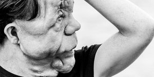 Η ομορφιά είναι κάτω από το δέρμα: Πάσχει από σπάνια διαταραχή και τη χρησιμοποι