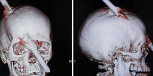 Του καρφώθηκε μία μεγάλη ράβδος στο κεφάλι αλλά αυτός επέζησε! [εικόνες]