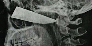 Η μήκους δέκα εκ. λεπίδα είχε καρφωθεί κάτω από το αριστερό μάτι του 25χρονου (Φωτογραφία: BMJ Case Reports) 