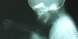 Φρίκη στη Συρία – Ελεύθεροι σκοπευτές βάζουν στο στόχαστρο εγκύους και τα αγέννη
