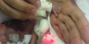 Γεννήθηκε μωρό ύψους 27 εκατοστών και βάρους 370 γραμμαρίων και επέζησε!