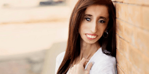 Παγκόσμια συγκίνηση από την υπέροχη ομιλία της «ασχημότερης γυναίκας του κόσμου»