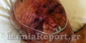 Σοκάρει η φωτογραφία του ηλικιωμένου που ξυλοκοπήθηκε άγρια από ληστές